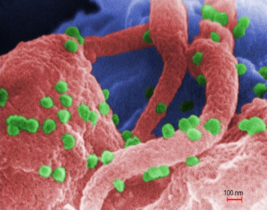 HIV-1 virions (green) can be seen on the surface of a lymphocyte. Image courtesy of the CDC