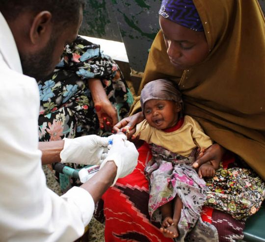 Malnourished child receives medical assistance in Mogadishu, Somalia 