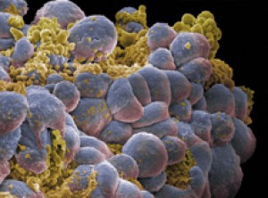 A cluster of breast cancer cells. Image by Annie Cavanagh. All rights reserved by Wellcome Images.