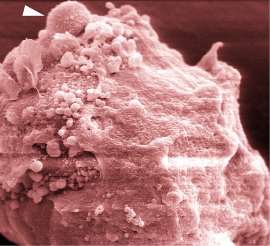 Scientists have identified a protein that cancer cells use to cut scaffolding that normally holds cells in place in the breast. Released from the scaffolding the cancer cells can spread to other tissues. In this electron microscope image of the mouse mammary gland, normal scaffolding, called the basement membrane, appears on the right. On the left, the membrane is degraded, and one cell (white arrow) can be seen bulging out.