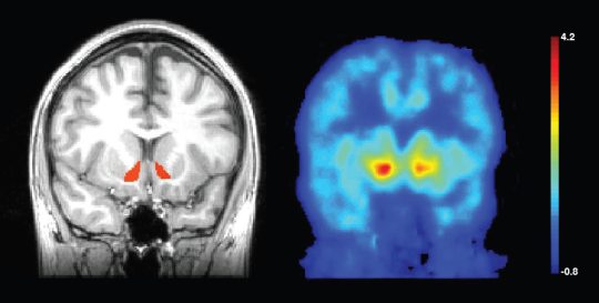 The nucleus accumbens, hand drawn in red on the MRI brain scan (left) of a control subject, produces feelings of pleasure. When carfentanil, an opiate-like drug, was given, it bound to opioid receptors in the region, as seen in red on the PET scan (right). When subjects drank alcohol, naturally occurring opioids, or endorphins, were released and bound to the same receptors, preventing cartenefil from binding. Image by Science/AAAS
