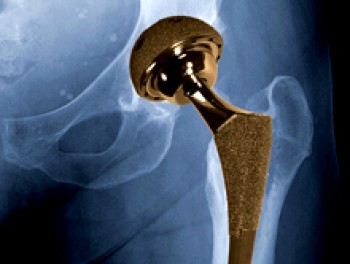 X-ray of the hip region with a metal-on-metal implant superimposed.