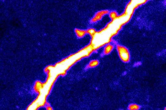 Images courtesy of Dong Kong/ BIDMC/ The scientists found that a 24-hour period of fasting — which causes intense hunger in the control mice — was associated with a 67 percent increase in the number of dendritic spines (pictured) on the AgRP neurons.