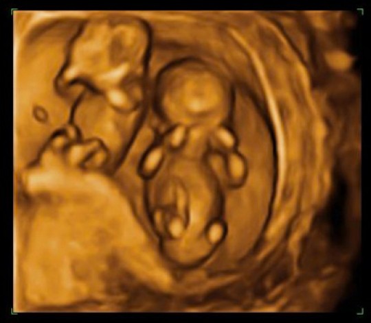 An image showing an early diagnosis of twins.