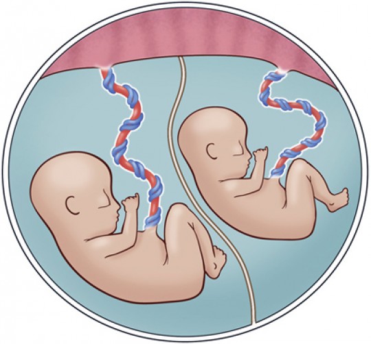 This illustration shows normal monochorionic twins, in which a single placenta is shared by two fetuses and no complications are present. The umbilical cord of each twin inserts anywhere into the placenta. Each twin has its own amniotic sac with a normal amount of amniotic fluid.