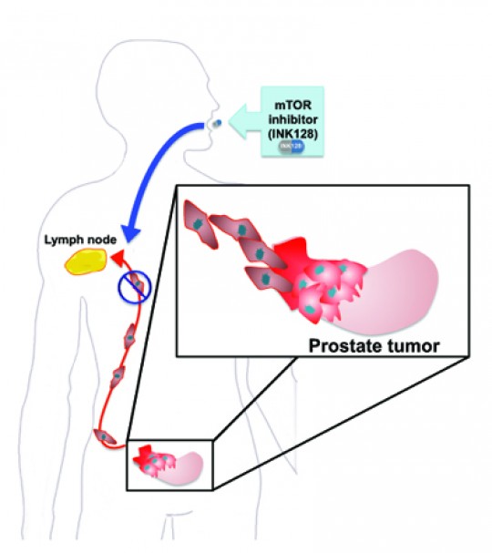 By sequencing genes while they produce proteins in cancer, Ruggero's team identified a group of proteins that lead to prostate cancer metastasis and can be targeted with a new drug INK128 that they developed. Credit: Davide Ruggero