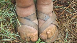 Podoconiosis is a tropical disease that leads to painful swelling and eventual disfigurement of the feet. Photo by Dr. Fasil Ayele, NHGRI.