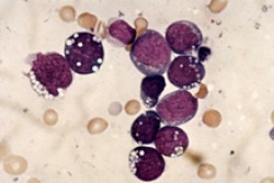 Burkitt lymphoma cells. Image courtesy of Wellcome Photo Library. All rights reserved by Wellcome Images.