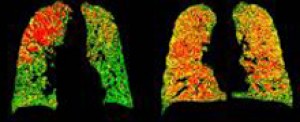 PRM images can help distinguish healthy lung areas (green) from those with early-stage damage (yellow) and emphysema (red). Image courtesy of University of Michigan Center for Molecular Imaging.
