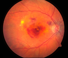 An eye affected by neovascular AMD, filled with abnormal blood vessels and yellow deposits called drusen. The white spot at the right is where the optic nerve leaves the eye. Image courtesy of NEI.