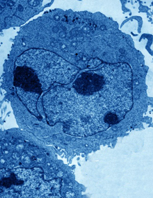 A lymphoblast, an abnormal cell occurring in lymphoblastic leukemia. Image by David Gregory and Debbie Marshall. All rights reserved by Wellcome Images.