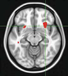 In people with major depression, low resting brain activity in the front part of the insula (red area where green lines converge on the right) predicted a higher likelihood of success with psychotherapy and a poor response to escitalopram. Source: Dr. Helen Mayberg, Emory University.