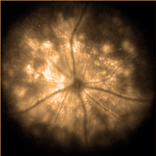 A fluorescent protein was produced across the mouse retina after its gene was delivered into the eye using a new technique. Image by the researchers, courtesy of Science Translational Medicine.