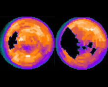 Computer-generated map of the heart of a twin without PTSD (left) and with PTSD (right). Image credit: Dr. Viola Vaccarino.