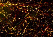 Accumulations of alpha-synuclein (red) and tau (green) in mouse brain cells treated with strain B. Overlap of the 2 proteins is shown in yellow. Courtesy of Dr. Virginia M.Y. Lee, University of Pennsylvania School of Medicine.