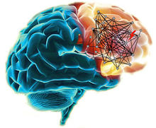 Schizophrenia networks in the prefrontal cortex area of the brain. Image courtesy of Dr. Mary-Claire King, University of Washington.