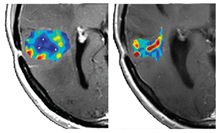 Vessel architectural imaging of a brain tumor before (left) and after (right) 28 days of drug therapy. Image by the researchers. Courtesy of Nature Medicine.