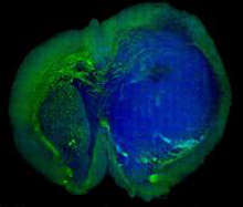 Stimulated Raman scattering, or SRS, microscopy can distinguish a human glioblastoma brain tumor (blue) from normal tissue (green) in a mouse brain. Credit: Xie lab, Harvard University