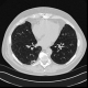 Helical CT scans reduce lung cancer mortality by 20% compared to chest X-rays