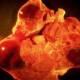 Safety Concerns About Experimental Cancer Approach ...
