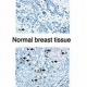 Breast Cancer Cells Outsmart the Immune System and Thrive 