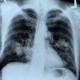 Annual Chest X-rays Don’t Cut Lung Cancer Deaths.