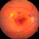 Cholesterol as Target for Age-Related Vision Loss