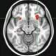 Brain Scan May Predict Best Depression Treatment