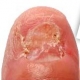 Nail Fungus Treatment. ZetaClear. Shocking Results.