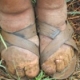 Genetics of a Tropical Foot Disease