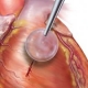 Nature-Inspired Surgical Glue Mends Hearts