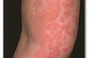 OxyHives Review. An Effective Natural Treatment of Hives.