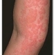 OxyHives Review. An Effective Natural Treatment of Hives.